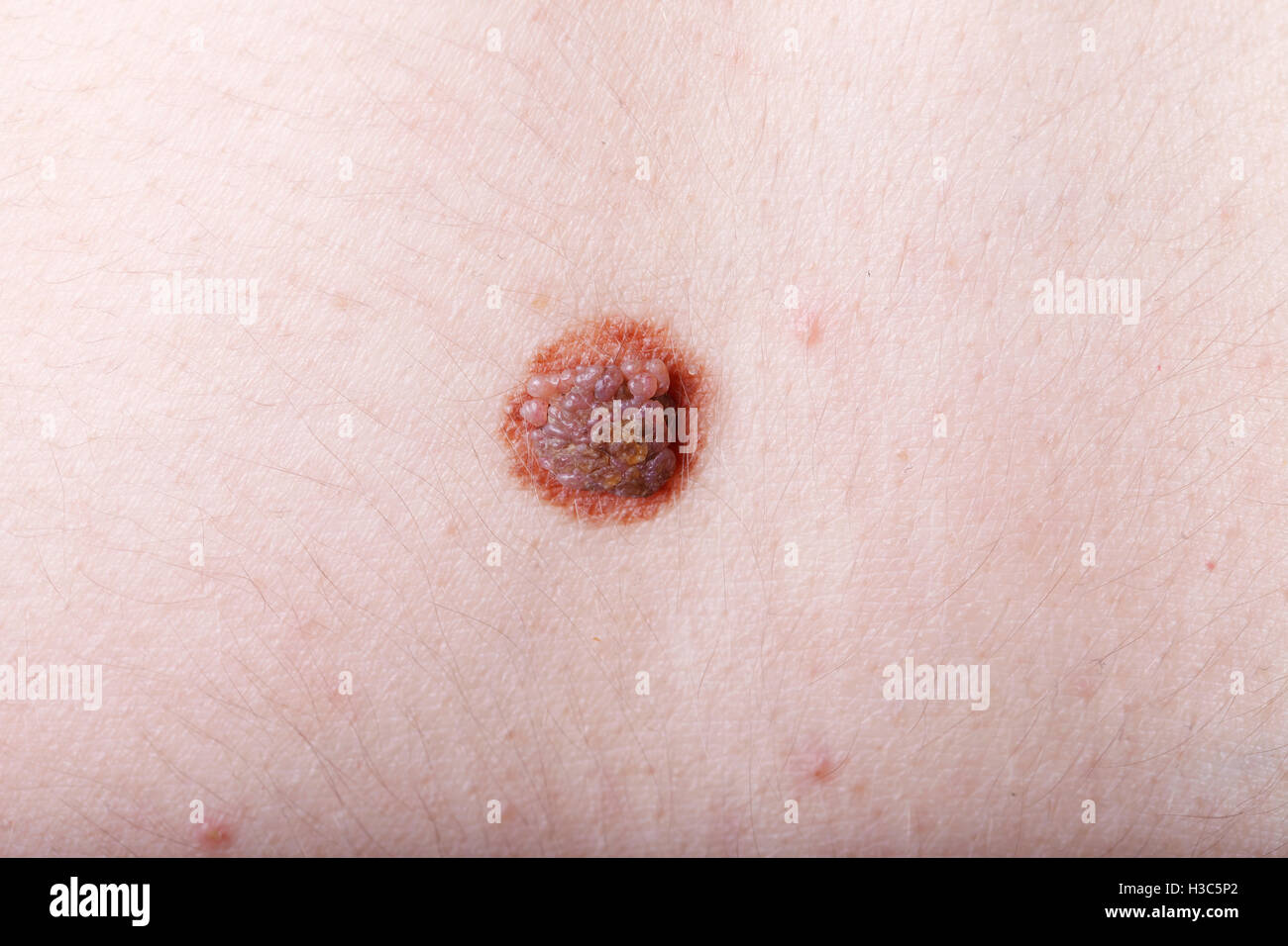Una grande mole sul corpo di una donna, close-up, Medicina, salute Foto Stock