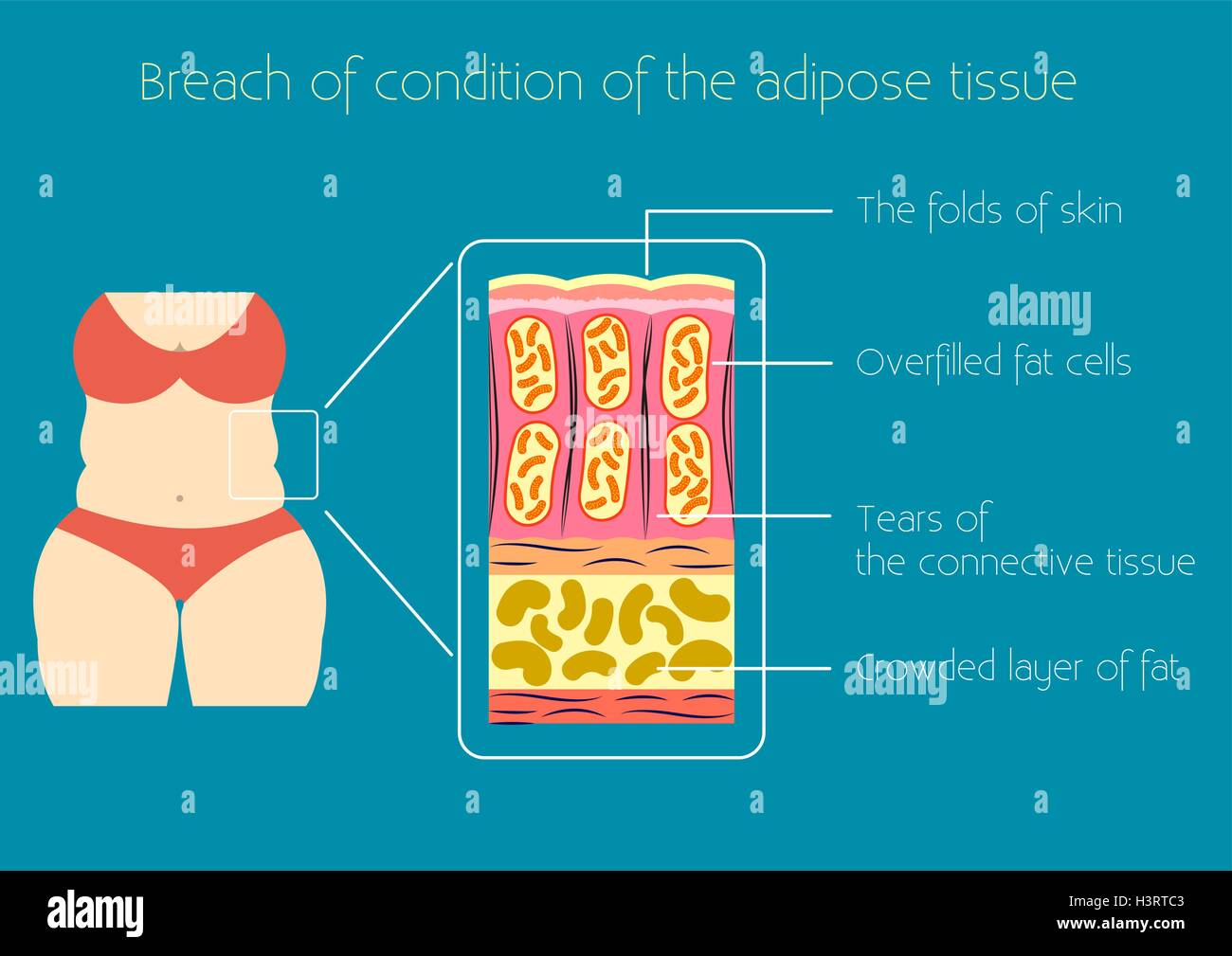 Obesità illustrazione vettoriale Illustrazione Vettoriale