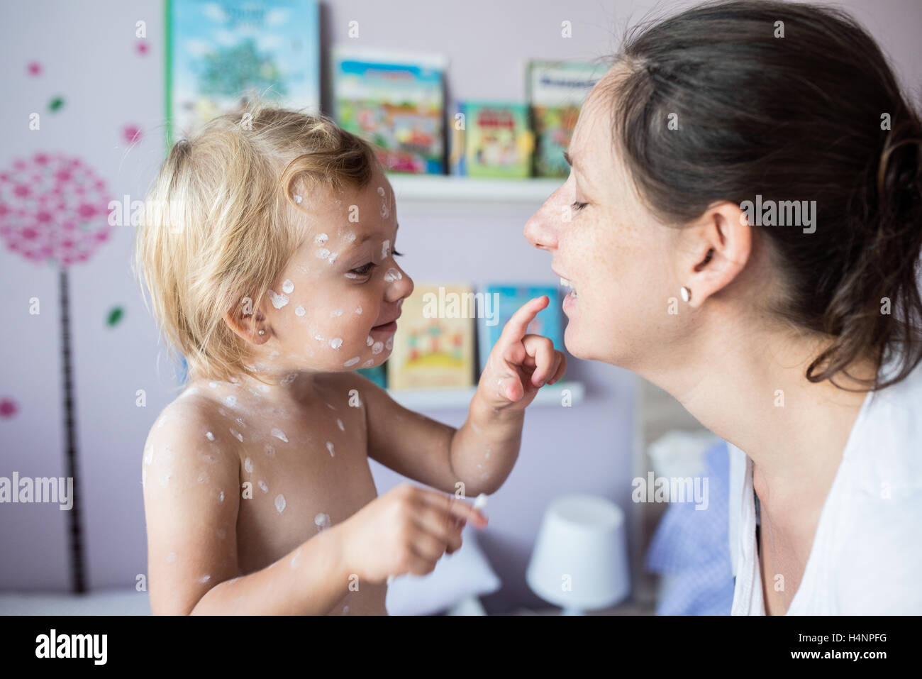 Bambina con la varicella, antisettico crema applicata alla ras Foto Stock