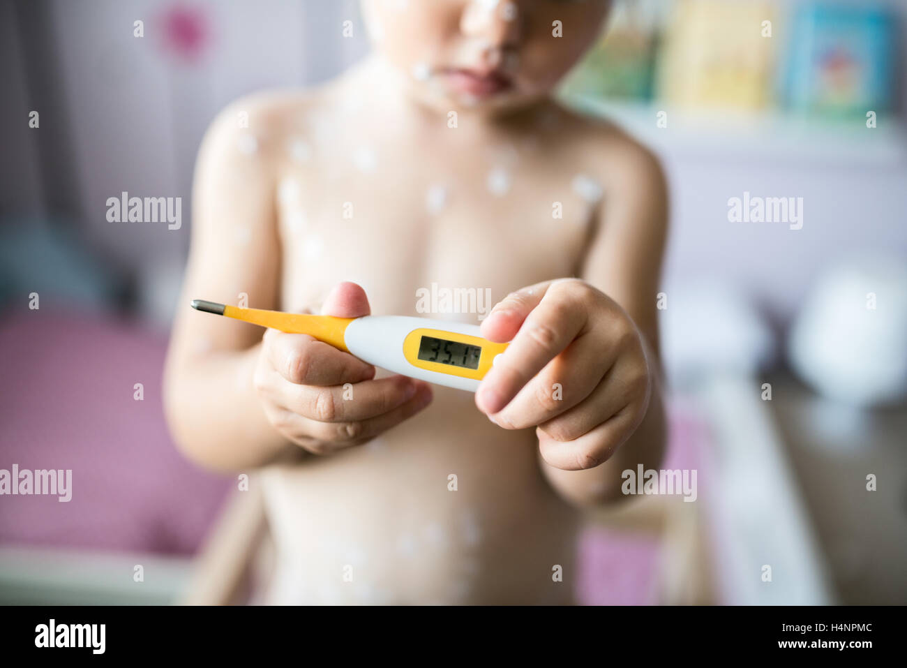 Irriconoscibile bambina con la varicella, tenendo il termometro Foto Stock