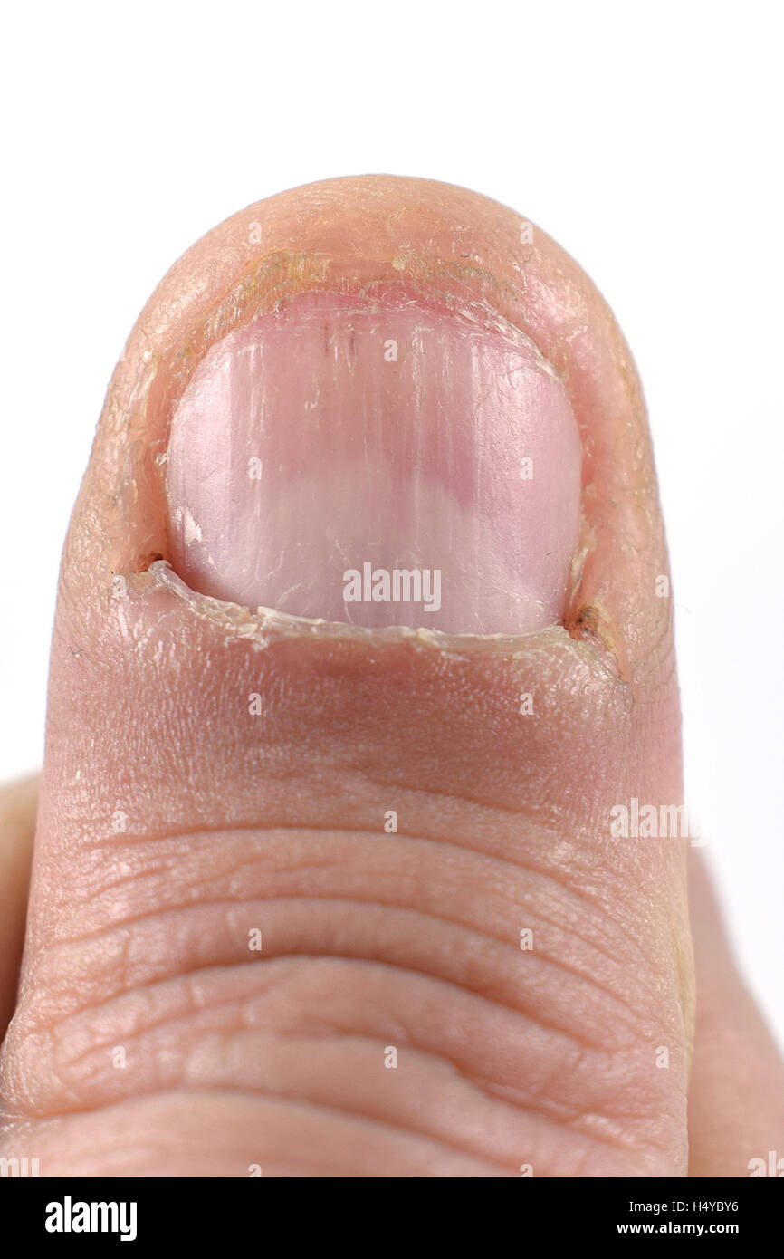 Primo piano della masticazione pollice unghie. Foto Stock