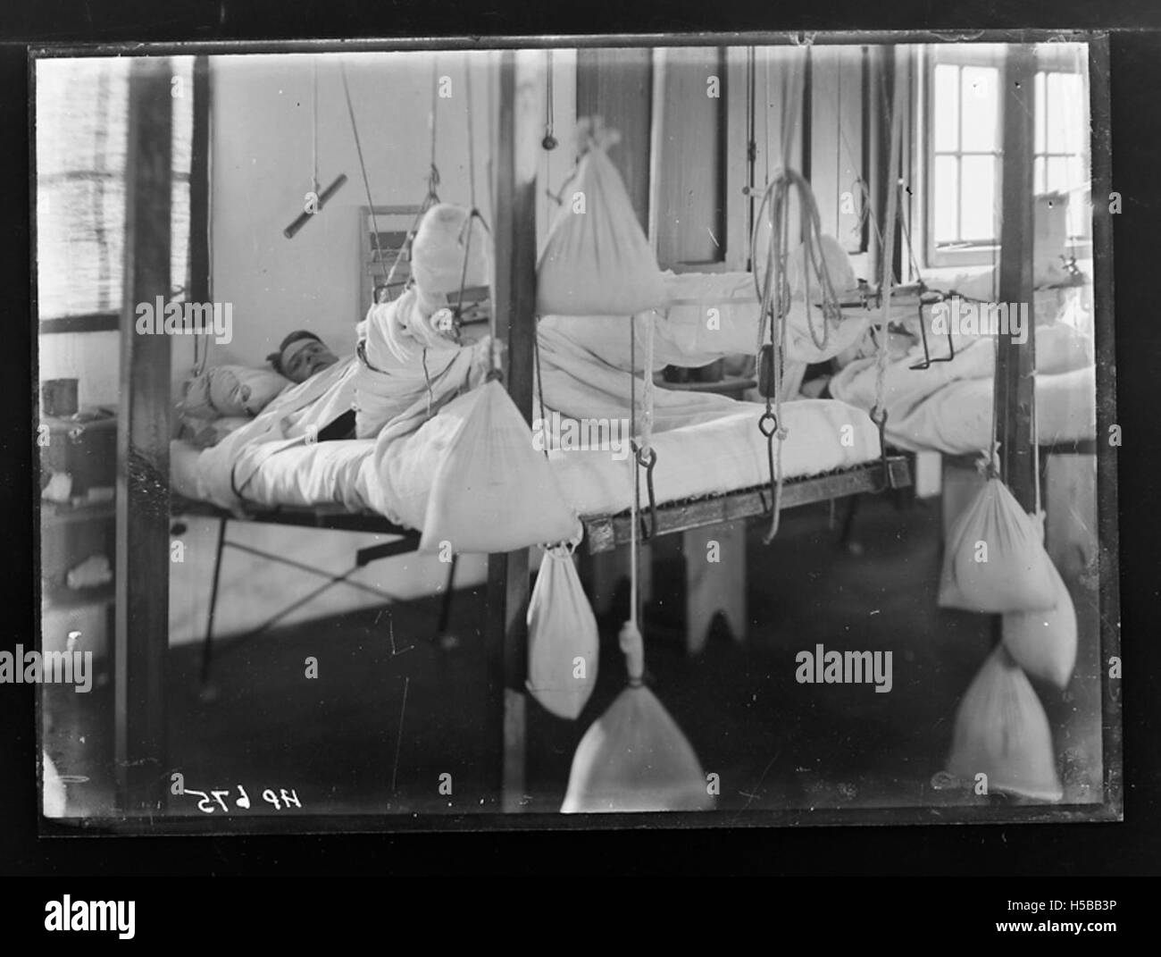 Un paziente che riceve un trattamento medico con la gamba in trazione. La trazione è un metodo di utilizzo di pesi e pulegge per trattare fratture o lesioni muscolo-scheletriche. Questa tecnica medica è stata comunemente usata in passato per aiutare con il recupero. Foto Stock