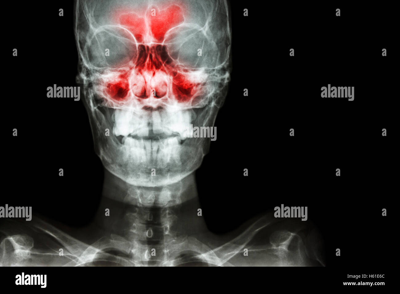 Sinusite. film x-ray cranio AP ( antero-posteriore ) mostrano infezione e infiammazione al seno frontale , sinusite etmoide sinus , maxil Foto Stock