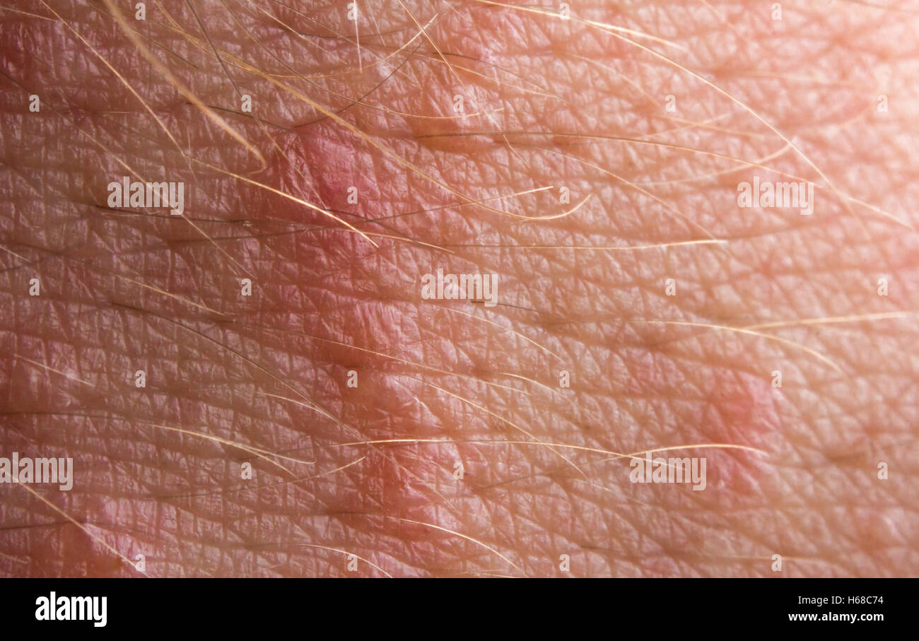 Close up macro poison ivy rash vesciche sulla pelle umana Foto Stock