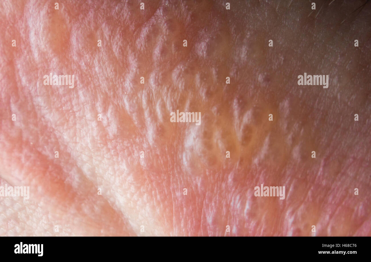 Close up macro poison ivy rash vesciche sulla pelle umana Foto Stock