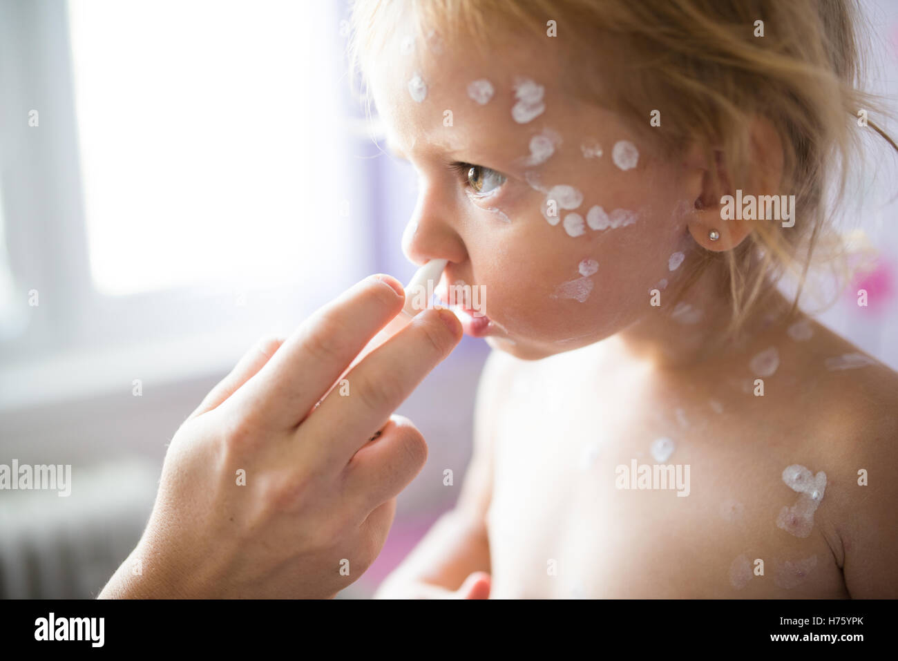 La ragazza con la varicella, antisettico crema applicata alla ras Foto Stock