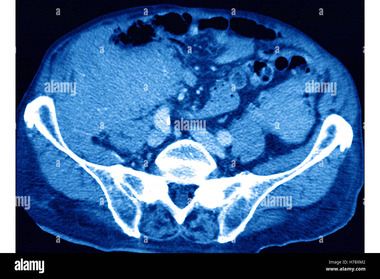 L'amiloidosi CT-SCAN Foto Stock