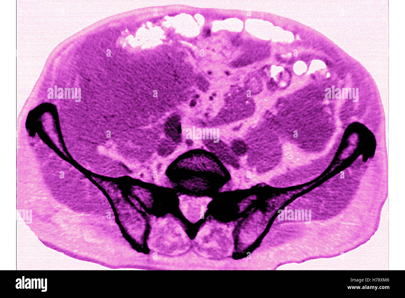 L'amiloidosi CT-SCAN Foto Stock