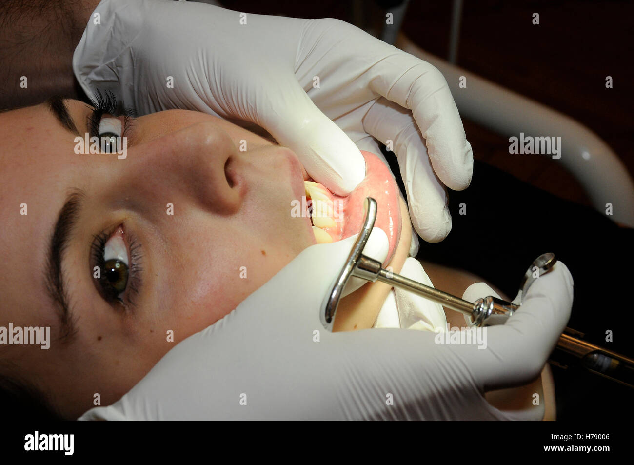 INNESTO GENGIVA Foto Stock