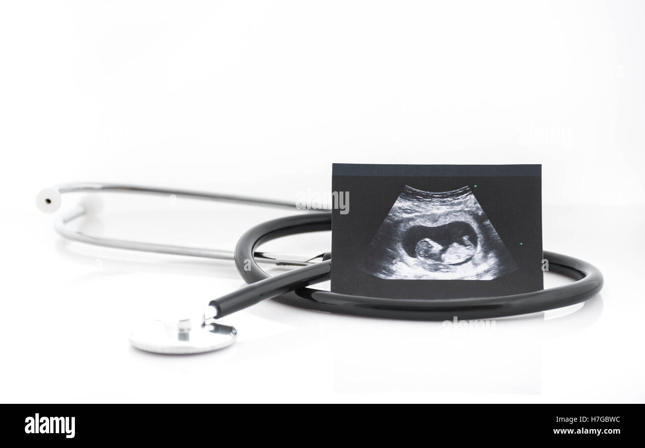 Immagini mediche collage di ultrasuoni durante la gravidanza della donna che mostra feto nel terzo mese e stetoscope su sfondo bianco Foto Stock