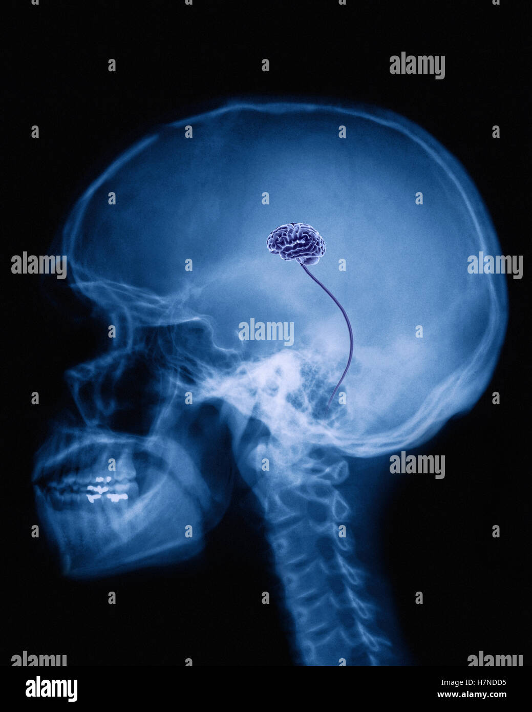 Raggi X del cranio umano con molto piccolo cervello Foto stock Alamy