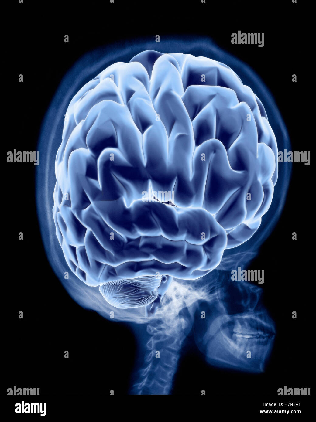 X-ray di gonfiato teschio umano con big brain Foto Stock