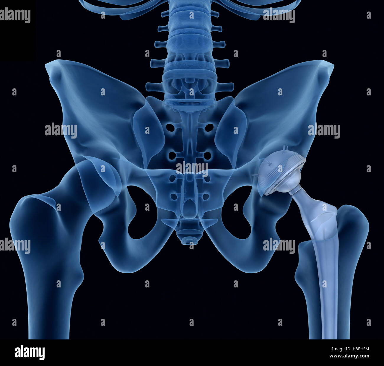 Anca sostituzione impianto installato in l'osso del bacino. Vista a raggi x. Accurata dal punto di vista medico 3D illustrazione Foto Stock