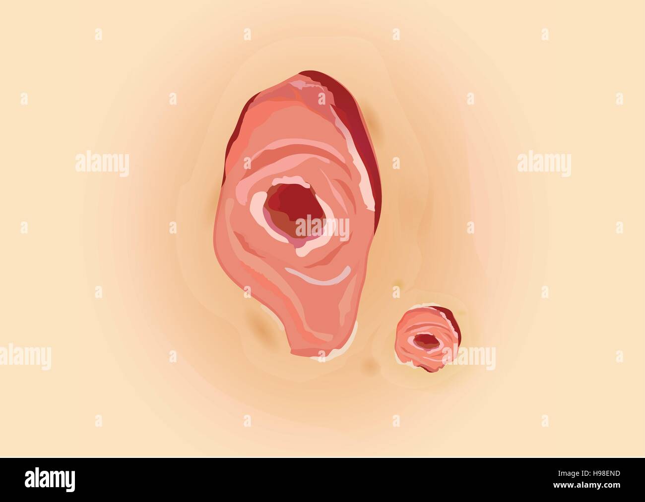 Ulcere della pelle dei pazienti diabetici. Illustrazione Vettoriale