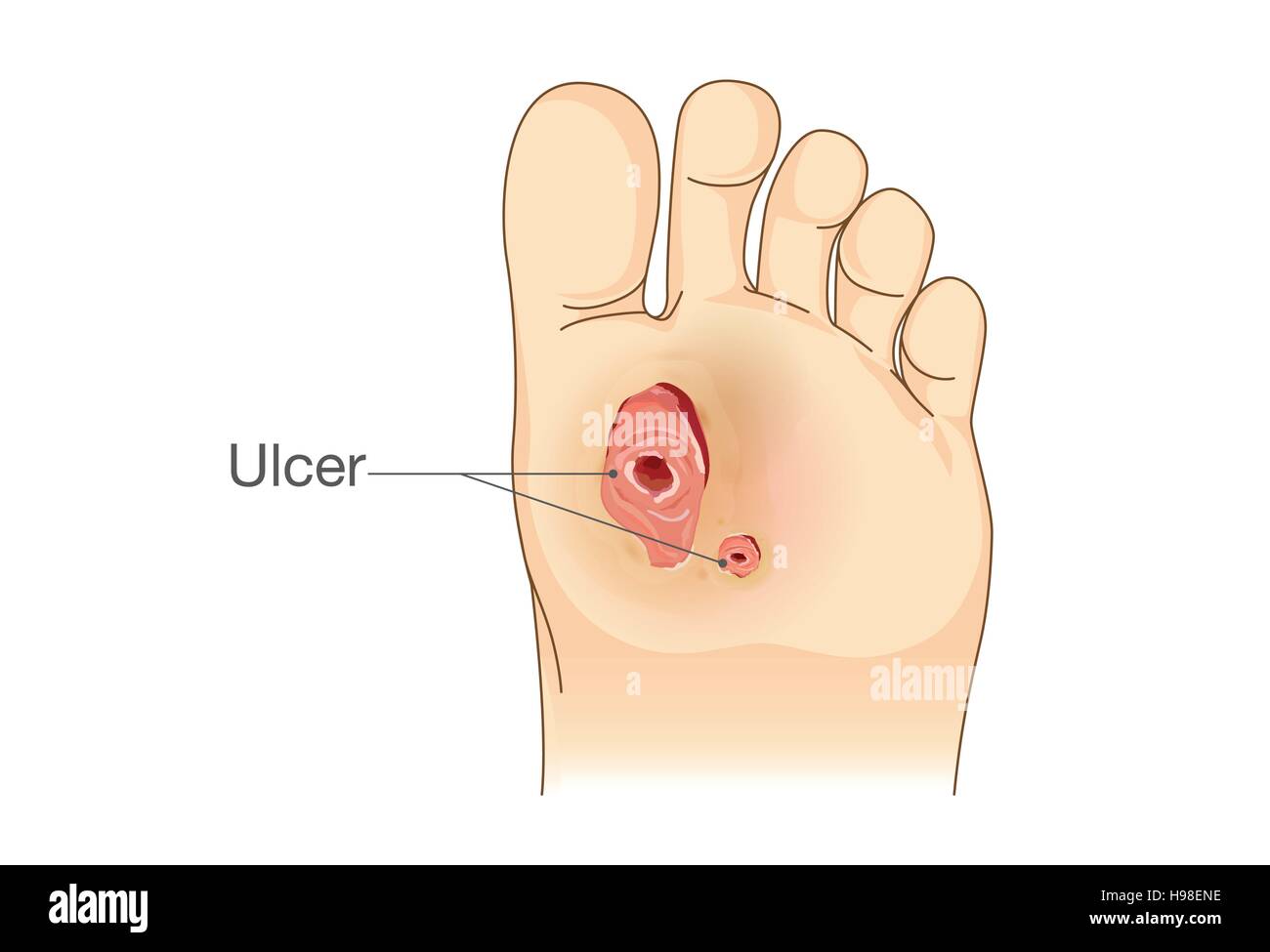 Piede diabetico dolore e ulcere. Illustrazione Vettoriale