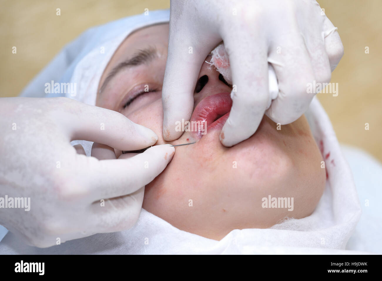 Procedura della faccia chirurgia di sollevamento Foto Stock