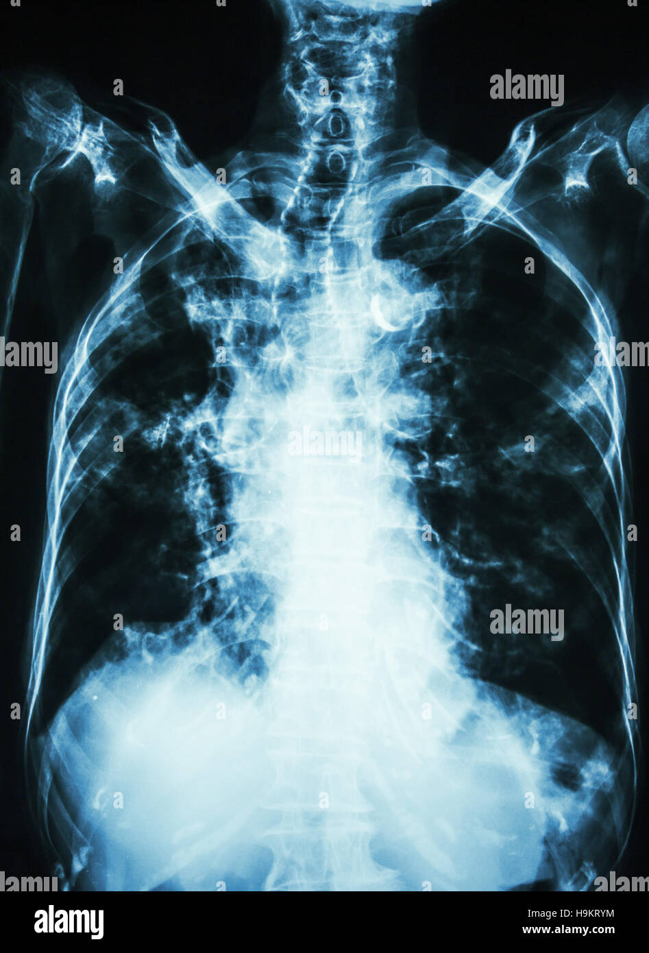 La tubercolosi polmonare . film i raggi x al torace del paziente precedente mostra infiltrazione interstiziale entrambi i polmoni e la calcificazione alla trachea ( si possono considerare la forma del T.R.A. Foto Stock La tubercolosi polmonare . film i raggi x al torace del paziente precedente mostra infiltrazione interstiziale entrambi i polmoni e la calcificazione alla trachea ( si possono considerare la forma del T.R.A. Foto Stock