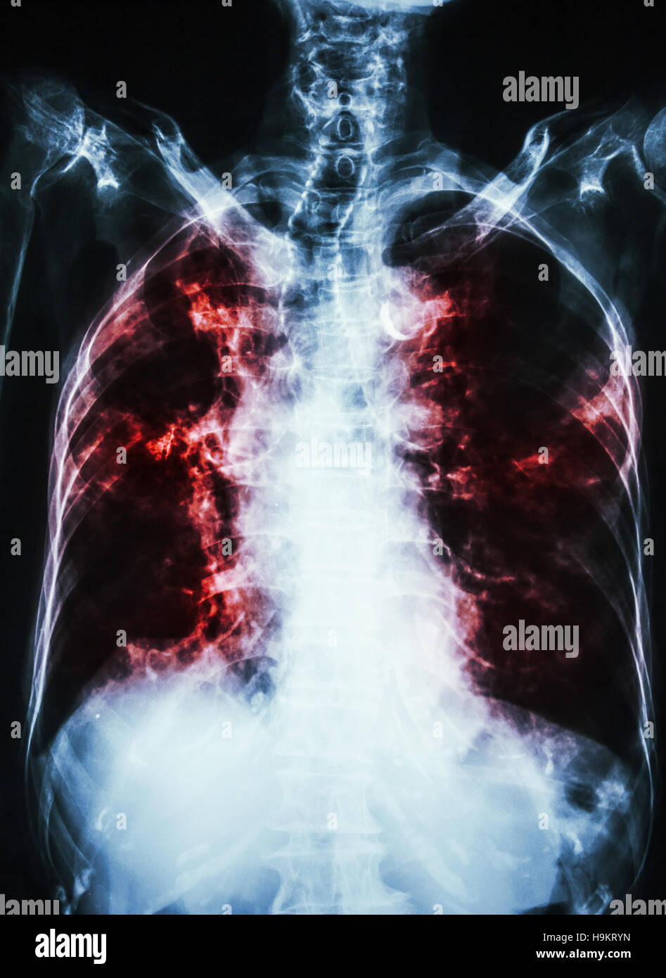 La tubercolosi polmonare . film i raggi x al torace del paziente precedente mostra infiltrazione interstiziale entrambi i polmoni e la calcificazione alla trachea ( si possono considerare la forma del T.R.A. Foto Stock La tubercolosi polmonare . film i raggi x al torace del paziente precedente mostra infiltrazione interstiziale entrambi i polmoni e la calcificazione alla trachea ( si possono considerare la forma del T.R.A. Foto Stock