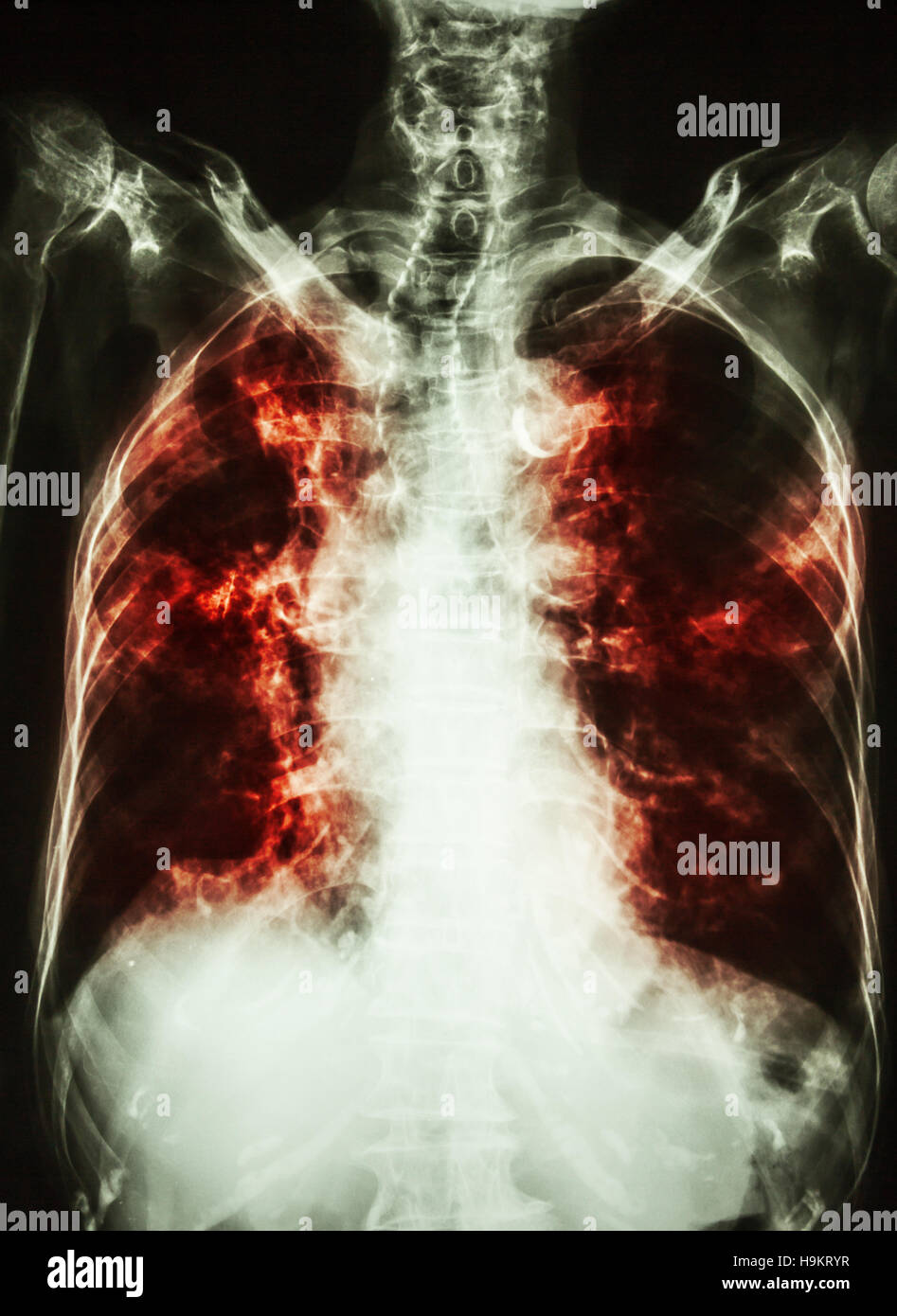 La tubercolosi polmonare . film i raggi x al torace del paziente precedente mostra infiltrazione interstiziale entrambi i polmoni e la calcificazione alla trachea ( si possono considerare la forma del T.R.A. Foto Stock La tubercolosi polmonare . film i raggi x al torace del paziente precedente mostra infiltrazione interstiziale entrambi i polmoni e la calcificazione alla trachea ( si possono considerare la forma del T.R.A. Foto Stock