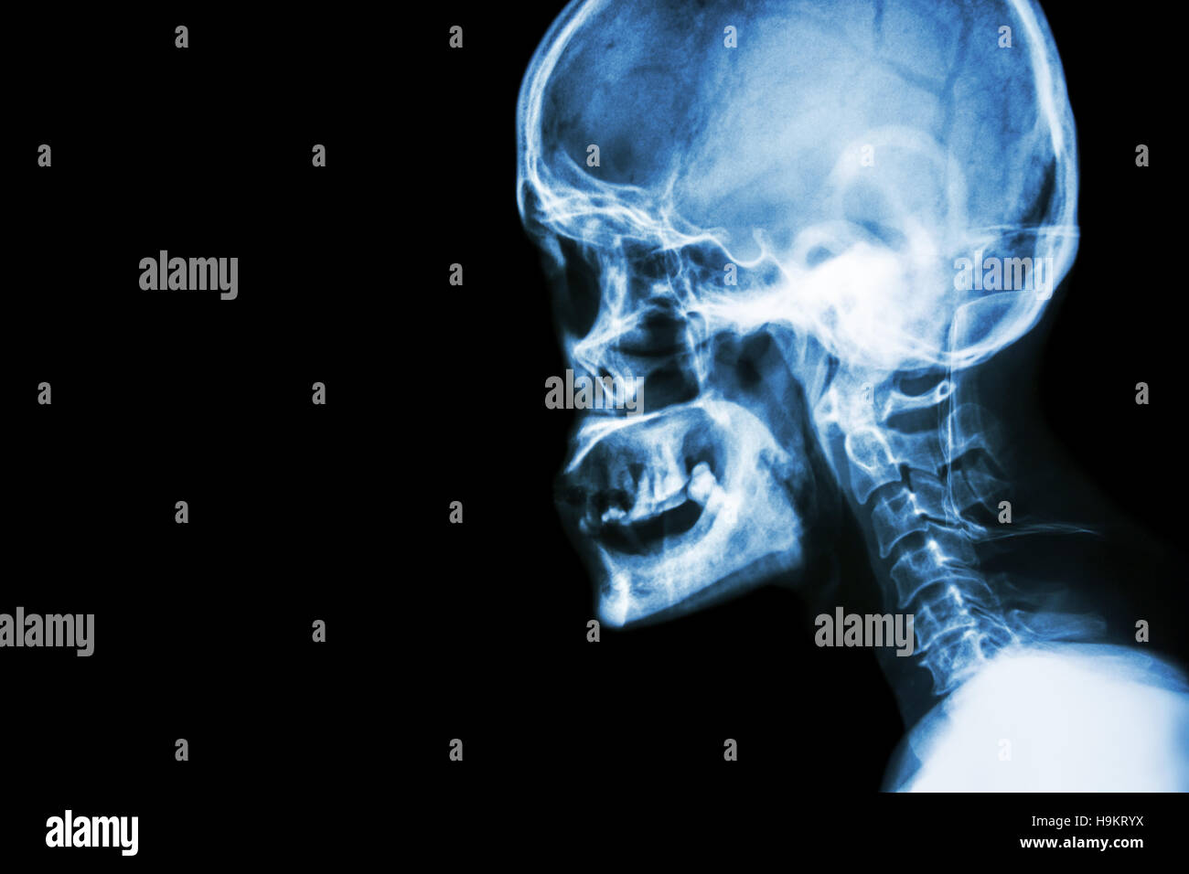Film x-ray cranio vista laterale mostra umano normale del cranio e della colonna vertebrale cervicale e la zona vuota a sinistra Foto Stock