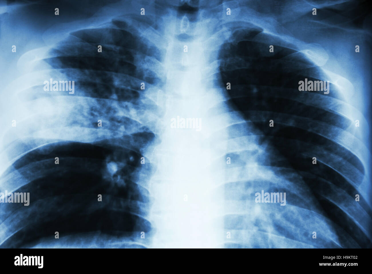 Lobar polmonite . film i raggi x al torace mostra infiltrazione alveolare a destra lobo centrale a causa di infezione da tubercolosi . Foto Stock