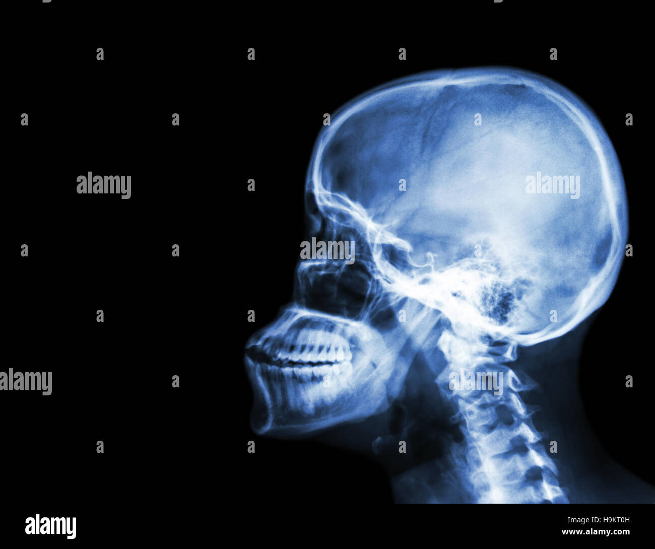 Film x-ray del cranio e della colonna vertebrale cervicale vista laterale . La zona vuota a sinistra Foto Stock