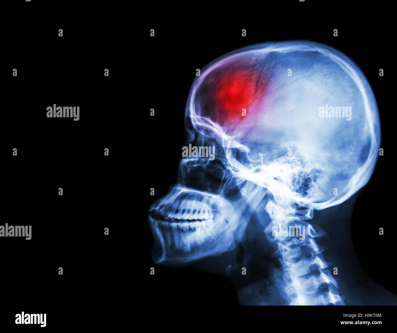 Stroke . il film x-ray del cranio e della colonna vertebrale cervicale vista laterale e corsa . accidente cerebrovascolare . La zona vuota a sinistra . Foto Stock