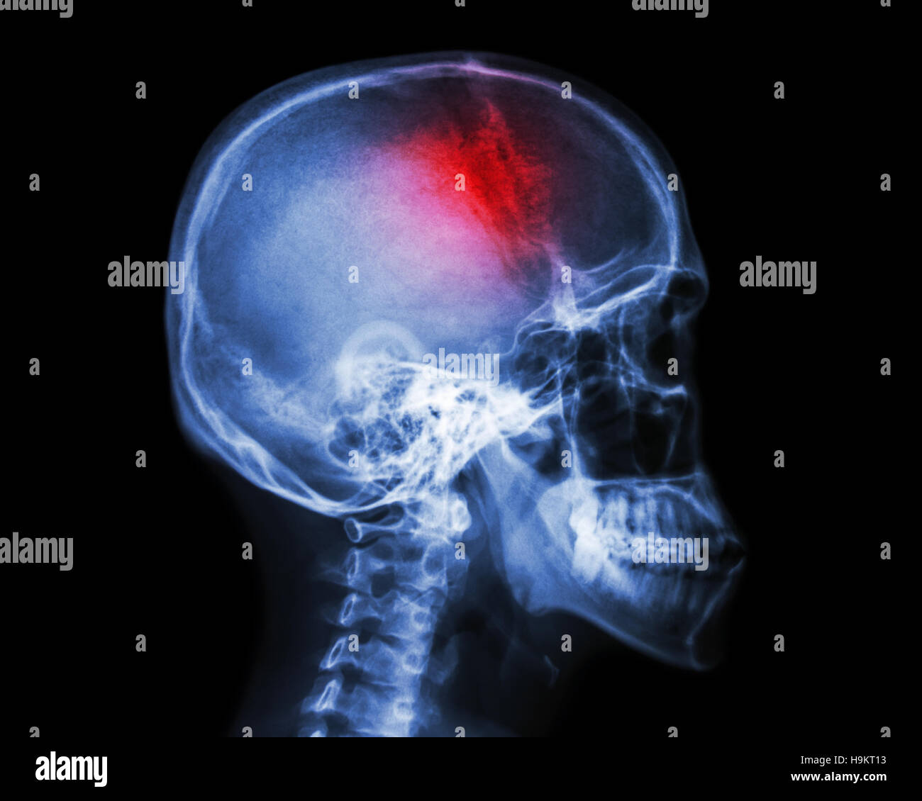Stroke . il film x-ray cranio vista laterale mostra teschio umano e corsa . accidente cerebrovascolare . sfondo isolato Foto Stock