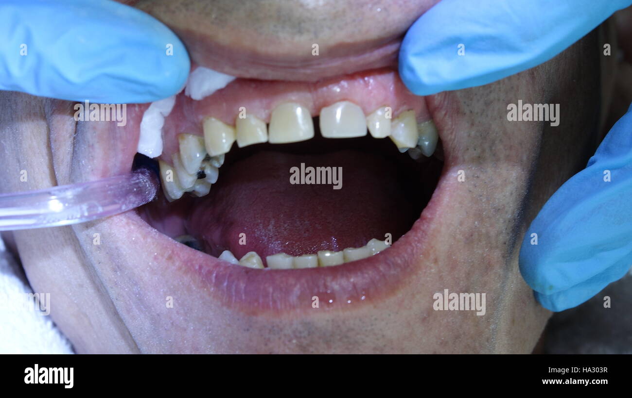 La pulizia dei denti e la bocca del paziente Foto Stock