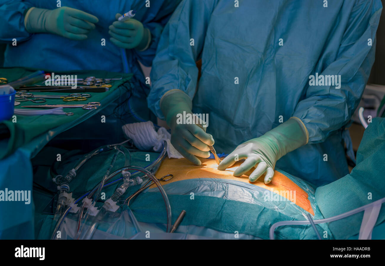 Chirurgo rendendo incisione- sostituzione di valvola cardiaca chirurgia, sala operatoria, Reykjavik, Islanda Foto Stock