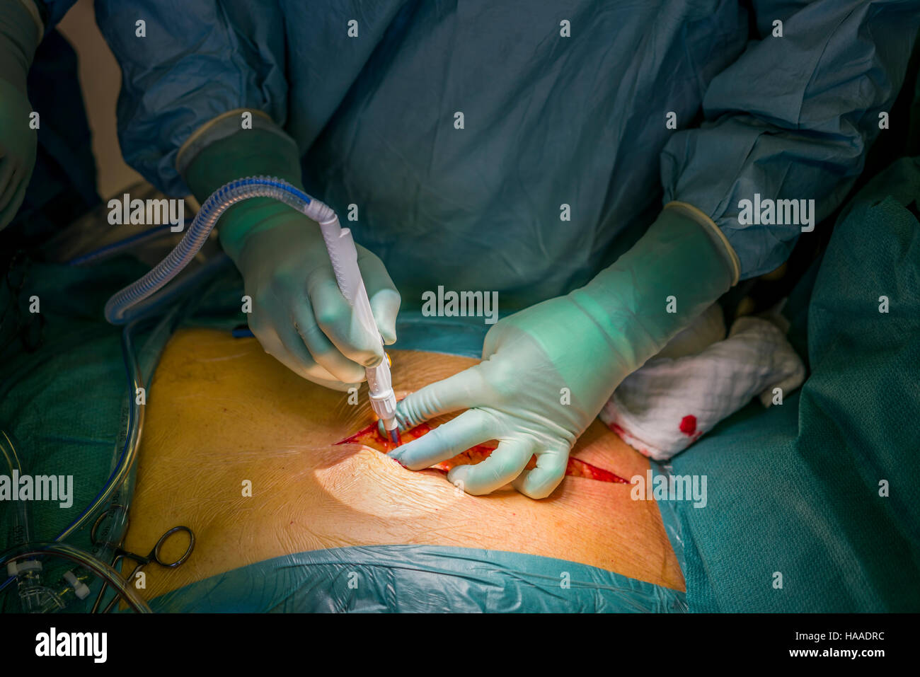Chirurgo aprendo il torace- sostituzione di valvola cardiaca chirurgia, sala operatoria, Reykjavik, Islanda Foto Stock