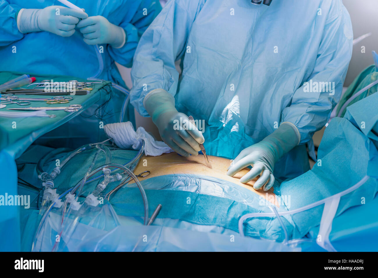 Chirurgo rendendo incisione- sostituzione di valvola cardiaca chirurgia, sala operatoria, Reykjavik, Islanda Foto Stock