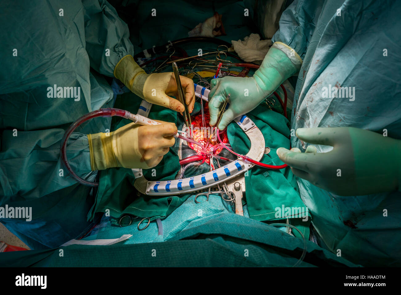 Sostituzione di valvola cardiaca chirurgia, sala operatoria, Reykjavik, Islanda Foto Stock