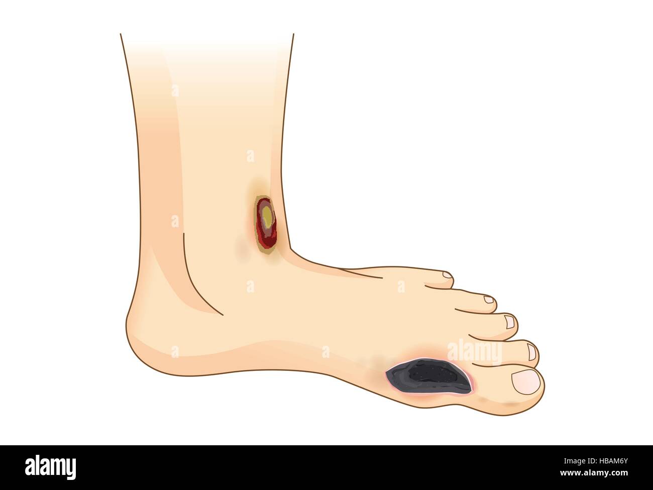 Piede diabetico dolore e ulcere. Illustrazione Vettoriale