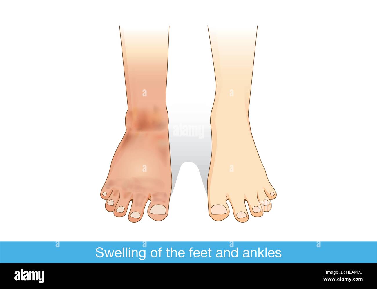 Gonfiore dei piedi e caviglie. Illustrazione Vettoriale