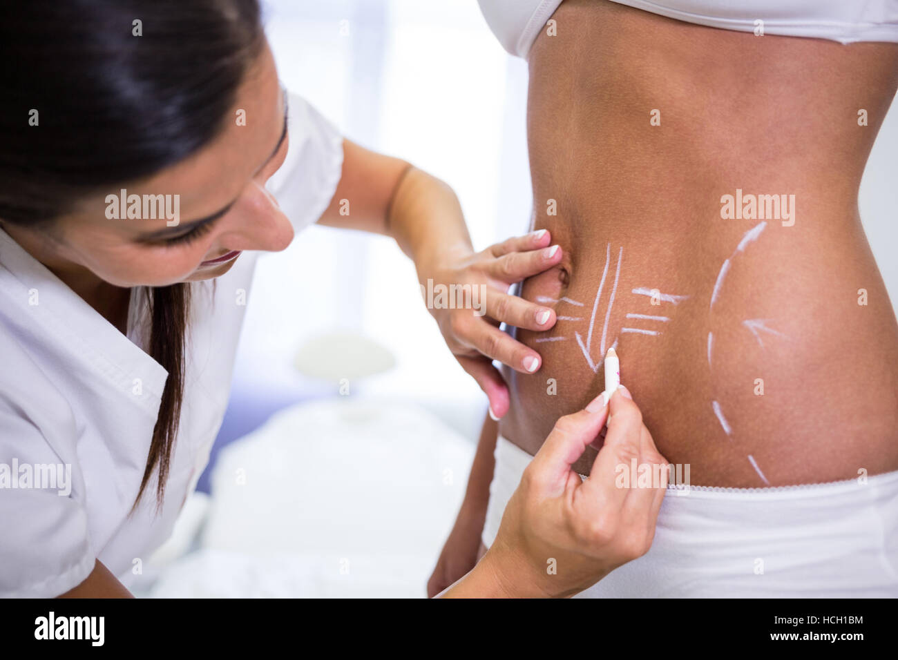 Chirurgo di tracciare linee su womans addome per la liposuzione e cellulite distacco Foto Stock