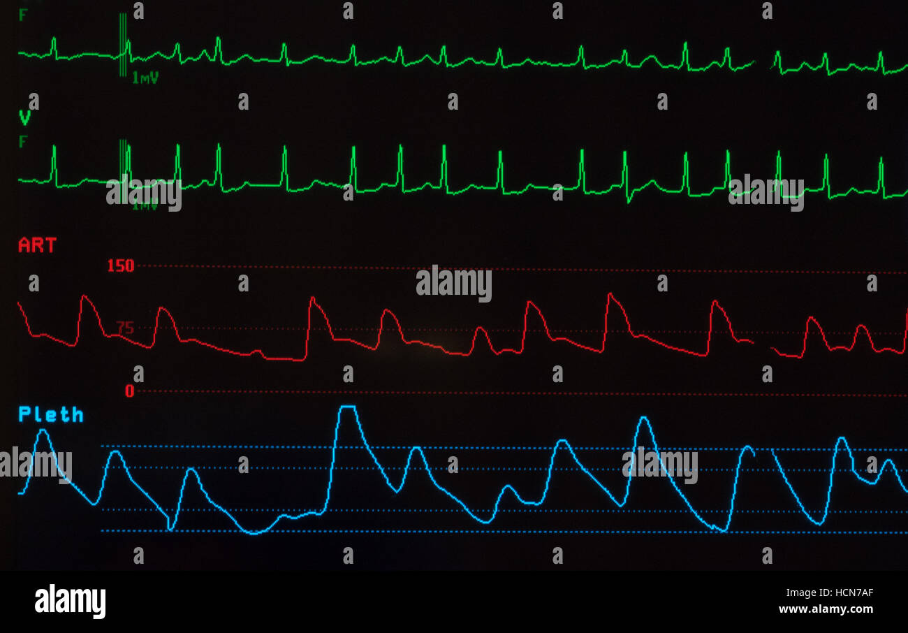 Close up monitor medicale con ECG con fibrillazione atriale, la pressione  del sangue arterioso onde e la saturazione di ossigeno a livello Foto stock  - Alamy