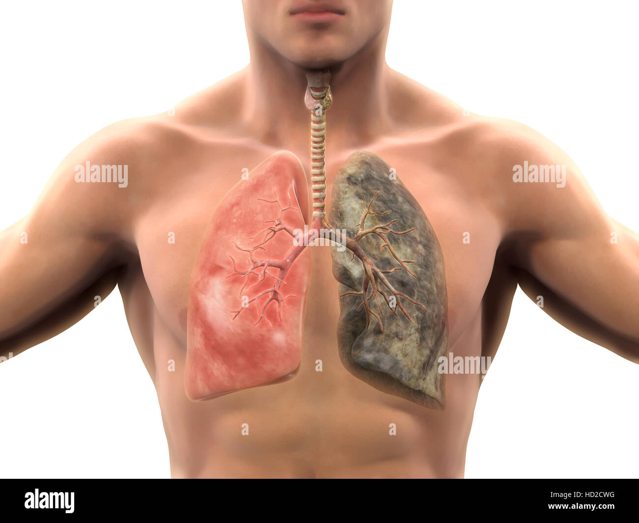 Polmone sano e il polmone per fumatori Foto Stock