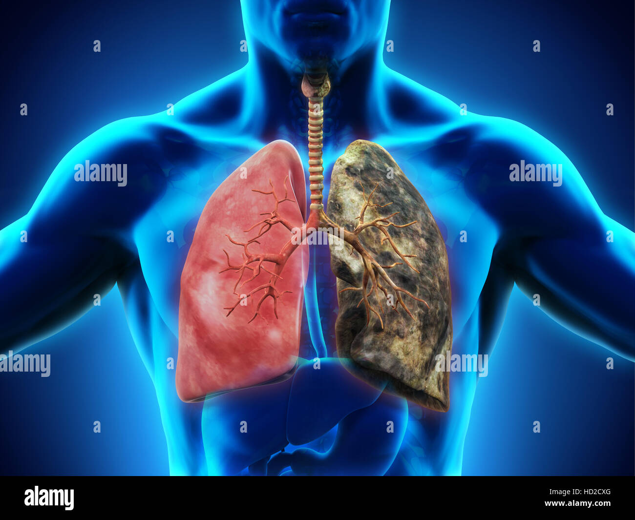 Polmone sano e il polmone per fumatori Foto stock - Alamy