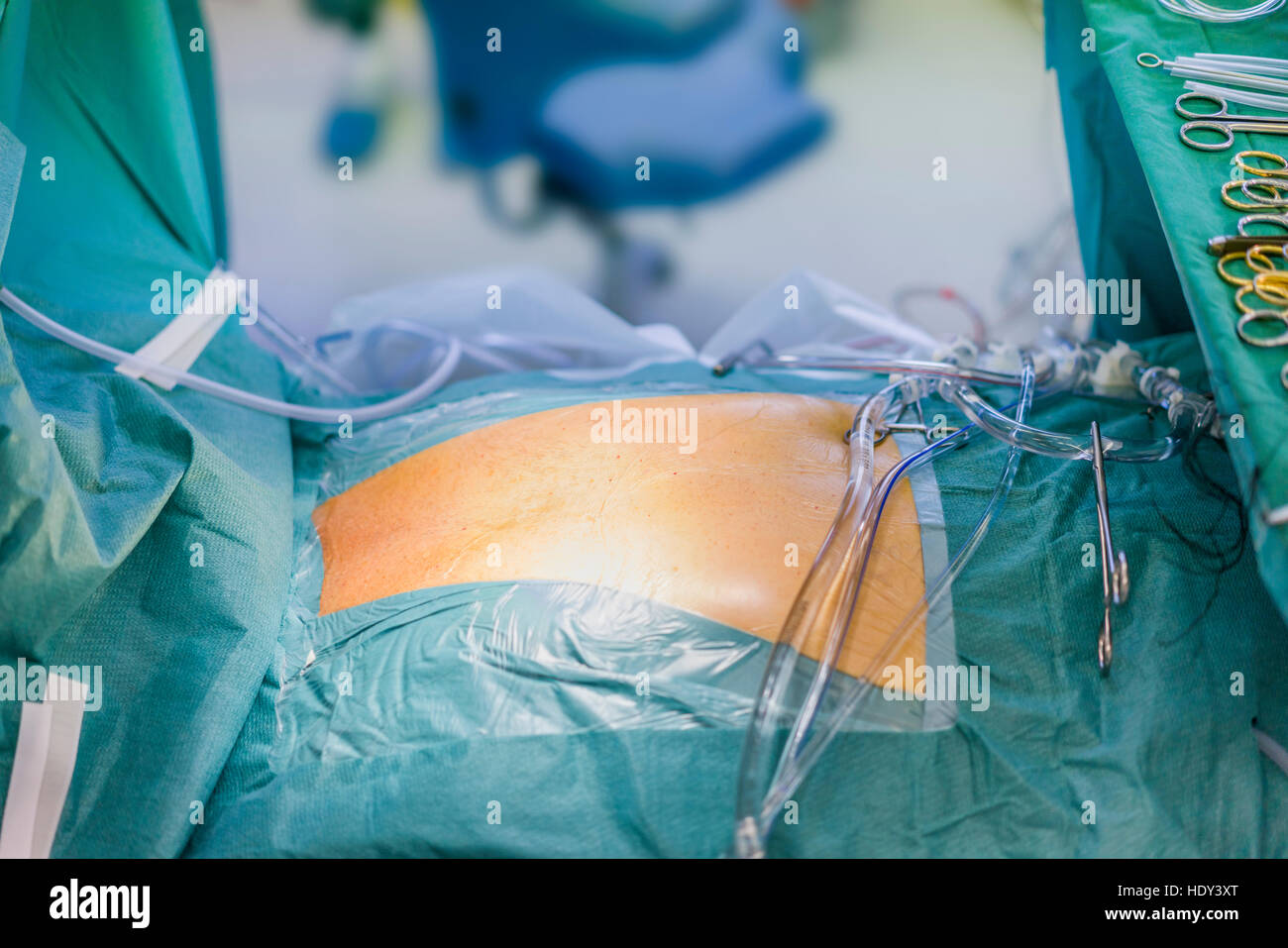 Paziente pronto per valvola cardiaca chirurgia di sostituzione, in sala operatoria, Reykjavik, Islanda Foto Stock