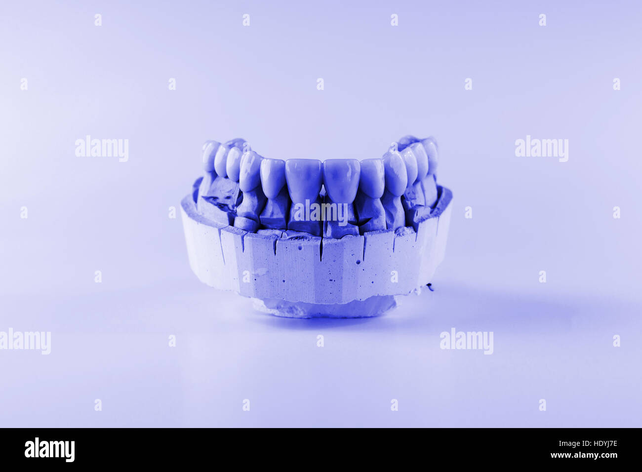 Dentiera di ceramica si trova sul modello in gesso Foto Stock