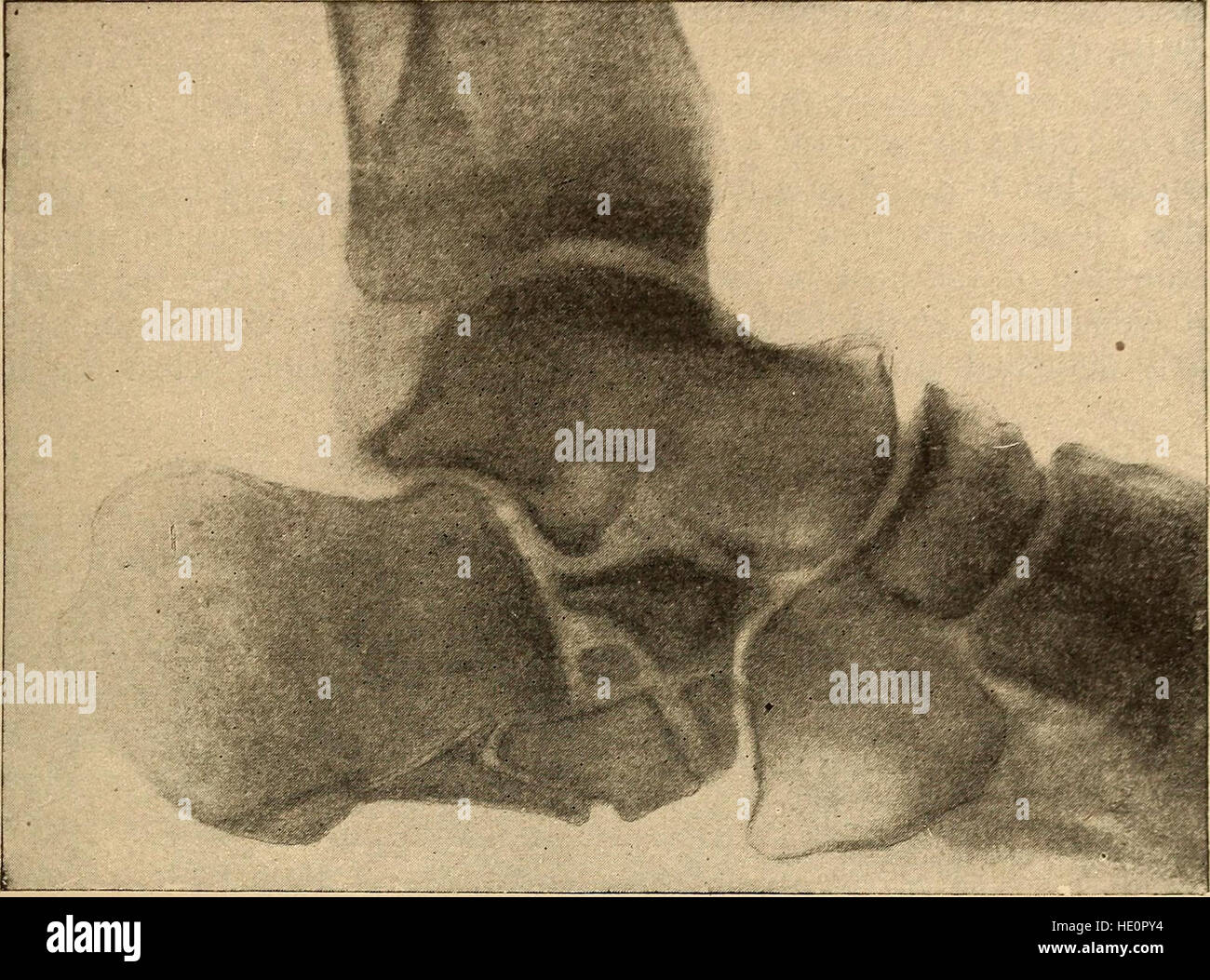 Questo trattato medico del 1912 fornisce informazioni complete sulla diagnosi, il trattamento e la riabilitazione di fratture e dislocazioni, con case study dettagliati e metodologie di trattamento. Foto Stock