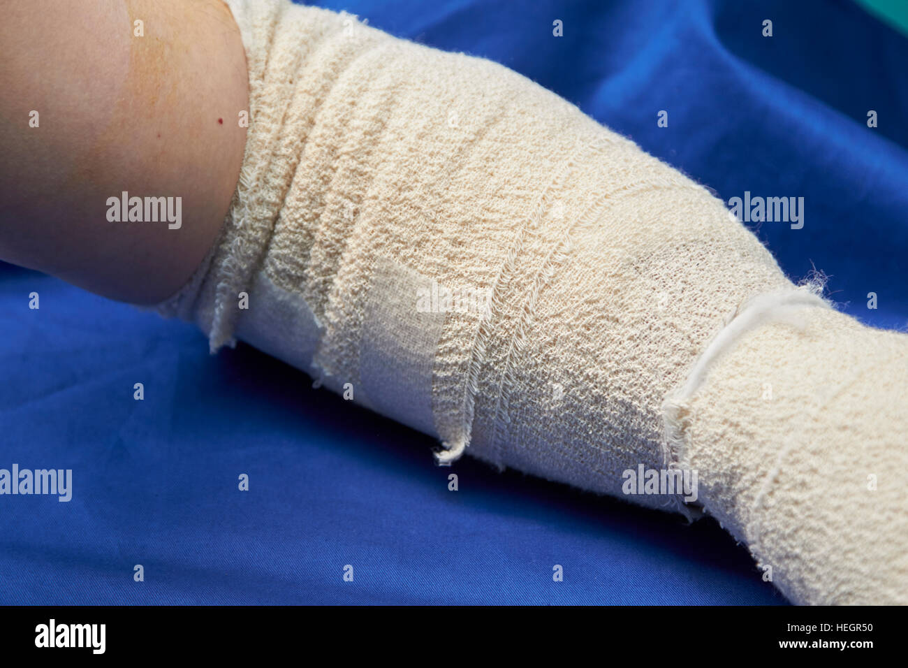 Bendato avambraccio sinistro dopo cubital e tunnel carpale chirurgia del pregiudizio Foto Stock
