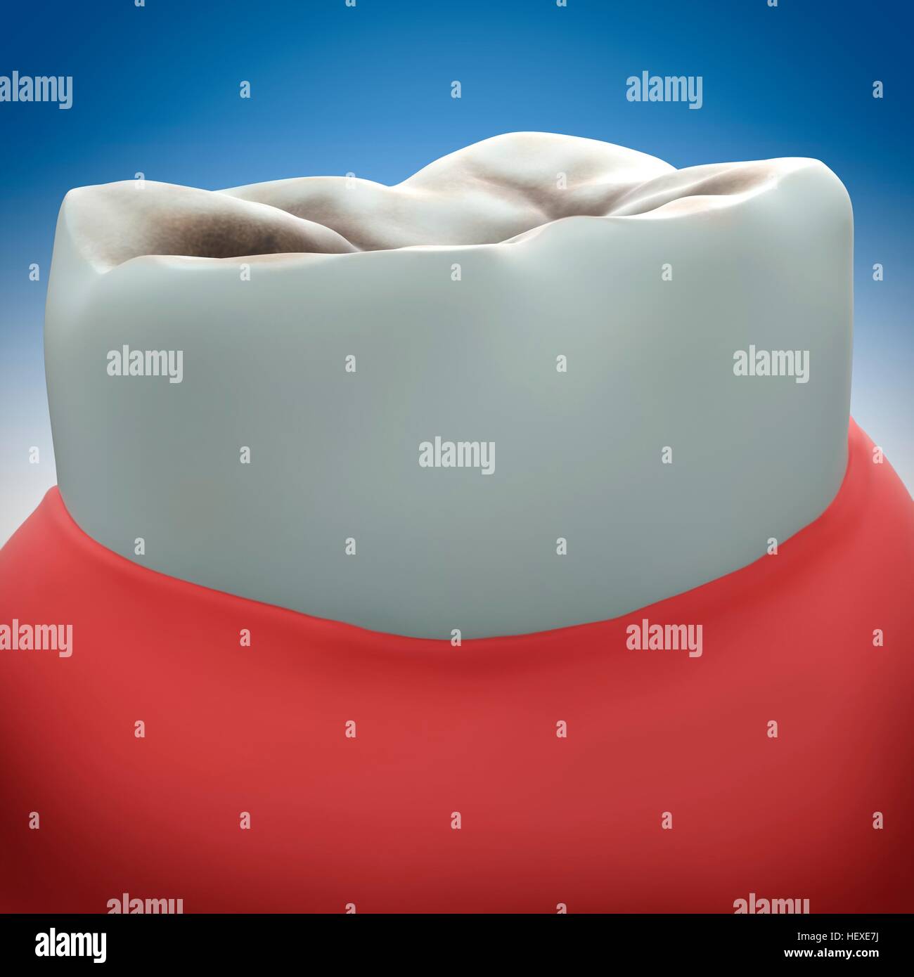 Dente molare del decadimento, illustrazione. Foto Stock