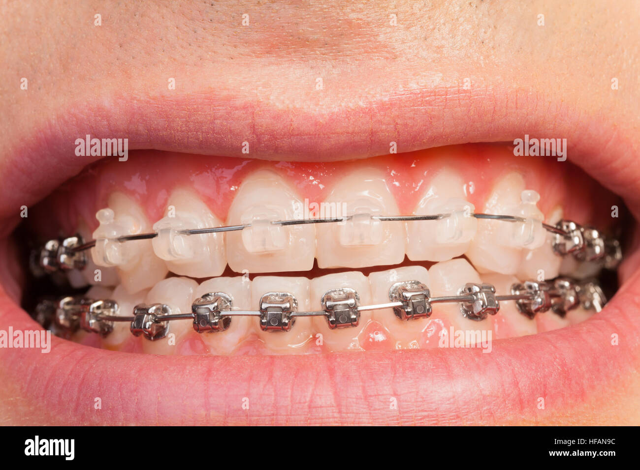 Bellissimo uomo di sorridere con casi ortodontico Foto Stock
