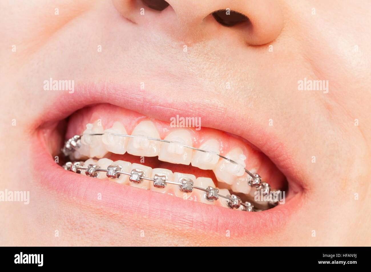 Uomo sorridente con bretelle ortodontico Foto Stock