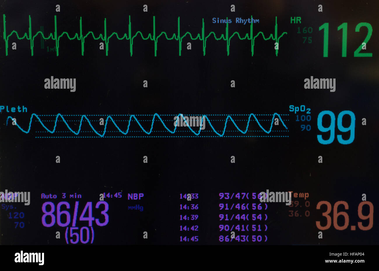 Monitor con ECG pediatrico del ritmo cardiaco, la saturazione di ossigeno, pressione sanguigna e temperatura su sfondo nero. Foto Stock