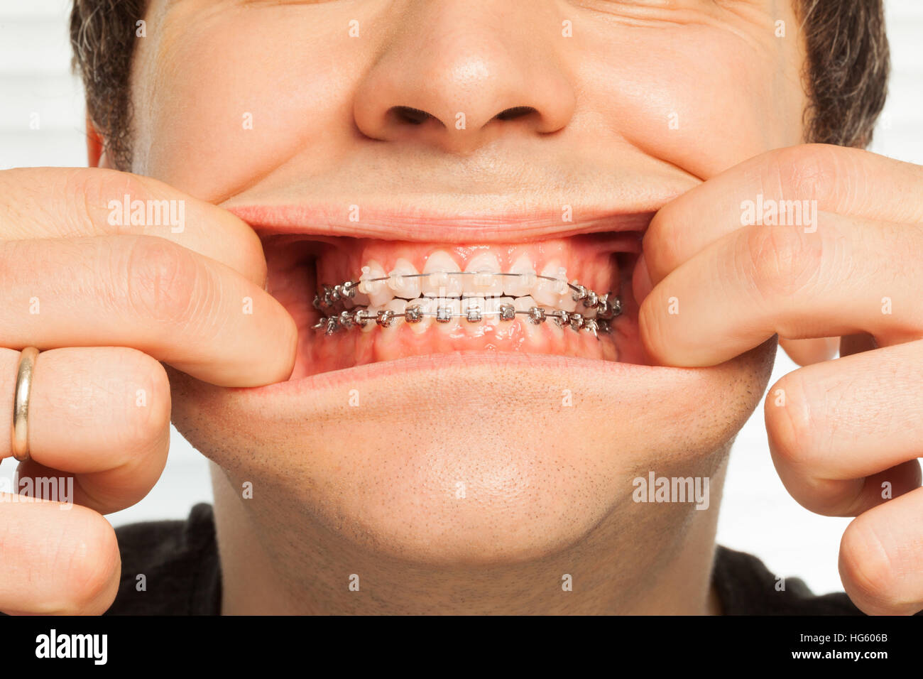 Ritratto di close-up di uomo che mostra le bretelle dentali Foto Stock