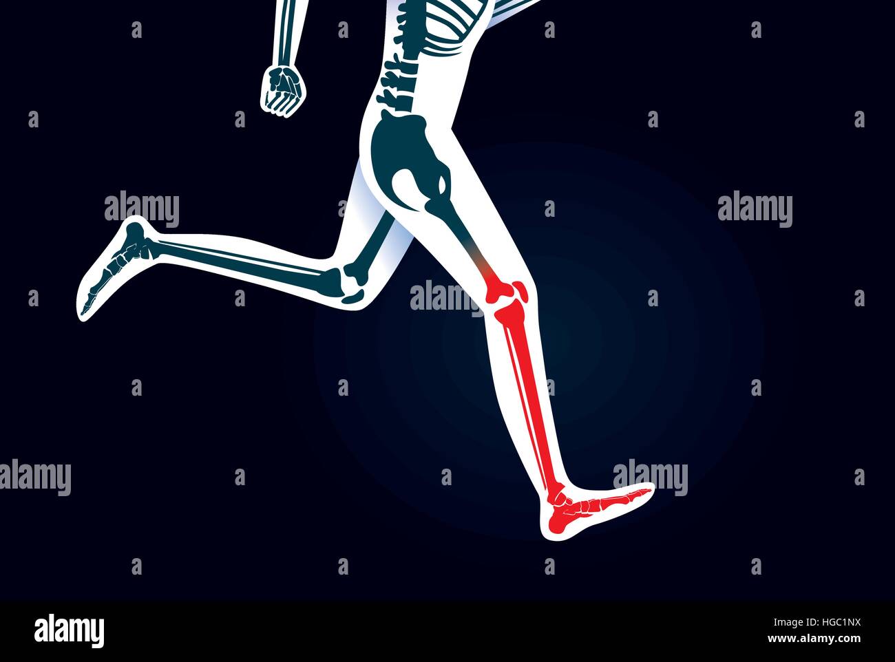 Gamba umana osso e il piede mentre esegui hanno un segnale rosso. Illustrazione Vettoriale