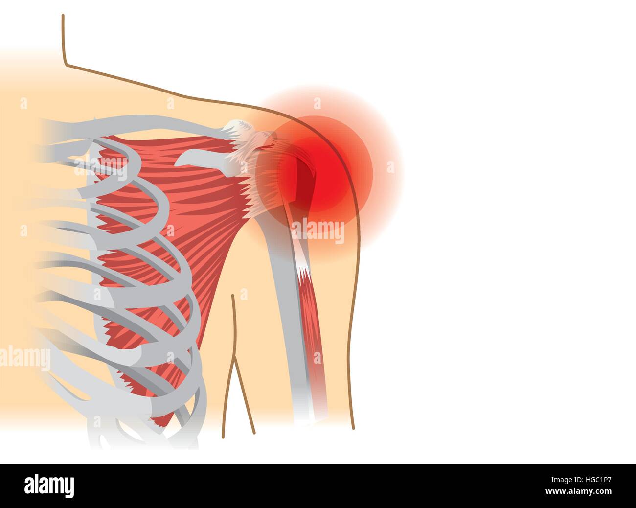 Spalla umana i muscoli e le articolazioni sono un segnale rosso. Illustrazione Vettoriale
